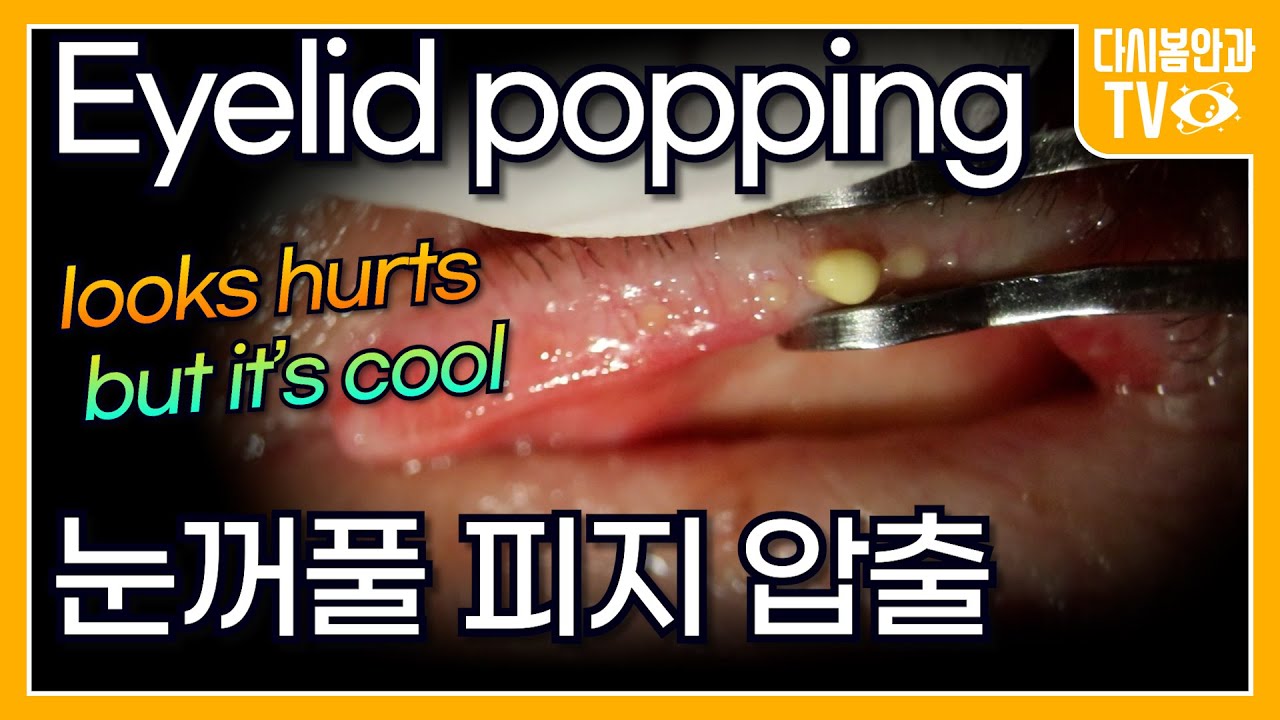 опухание век / выражение MGD / лечение сухости глаз