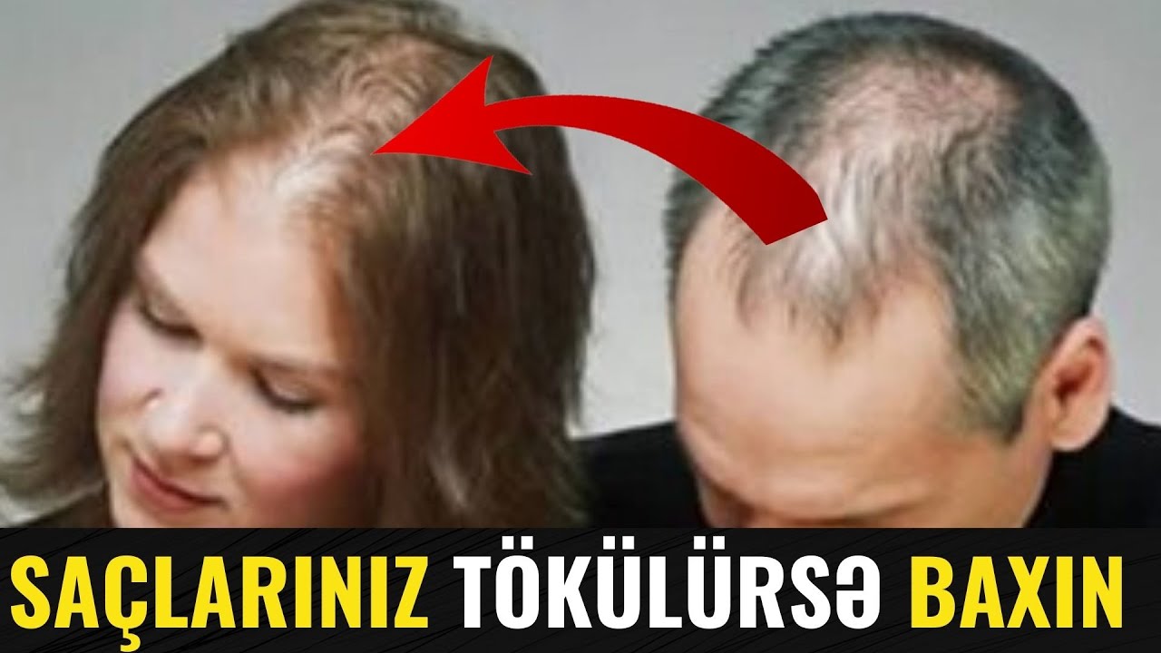 DİQQƏT! Saçlarınız tökülürsə, Çarəsi budur - Saç tökülməsinə son