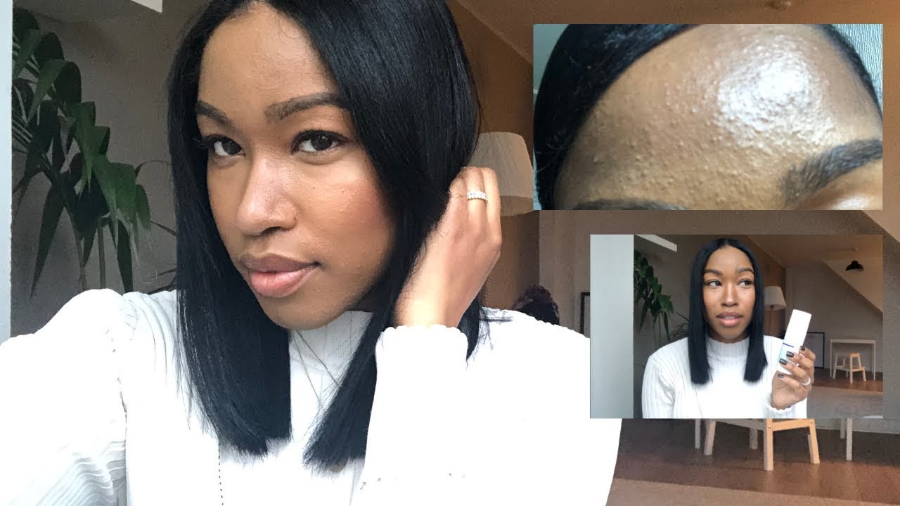 MY STUBBORN ACNE CLEARED IN 3 WEEKS!! (very detailed)