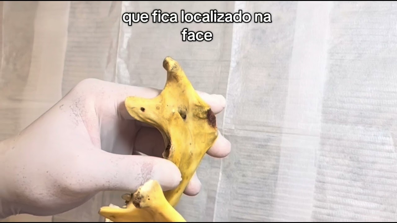 ODONTO I. [Cirurgia] - Técnica anestésica de NERVO BUCAL