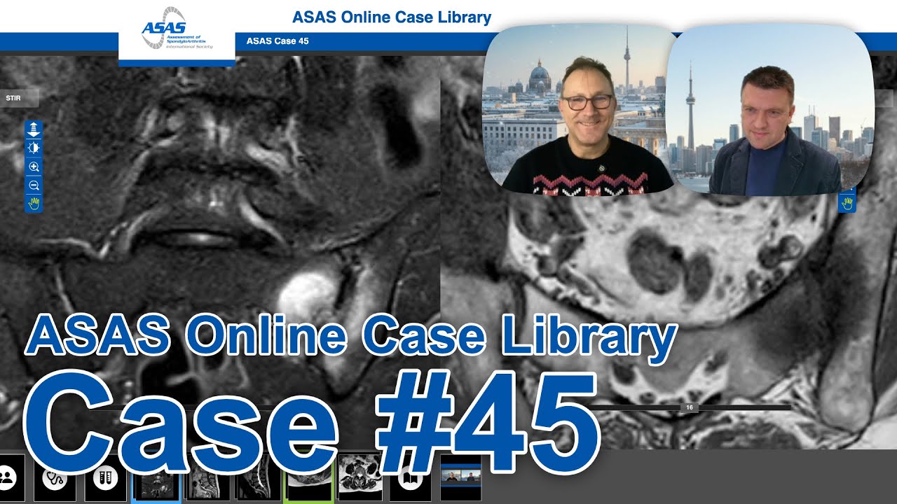 Case 45 of the ASAS Online Case Library // Late onset axSpA