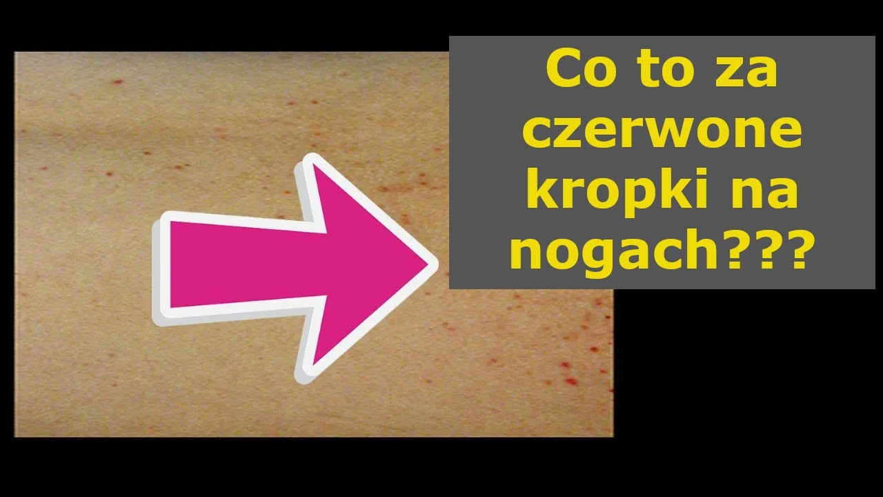 🩸Czerwone kropki, brązowe i żółte plamki na nogach. Co to za problem?