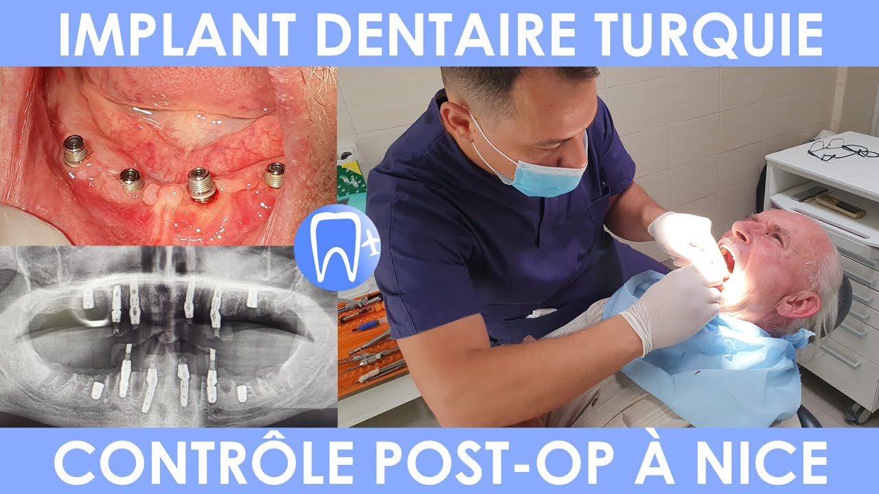 Implant dentaire Turquie - Suivi dentiste à Nice