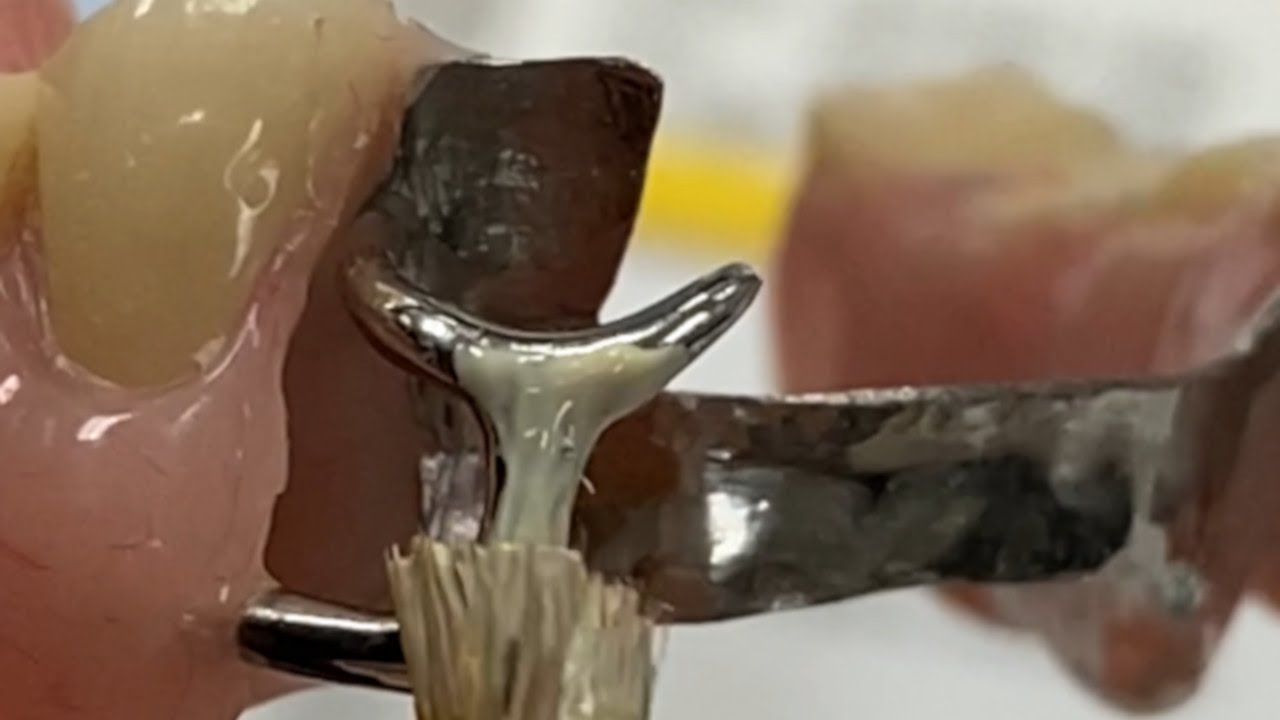 Acrylic Partial: Step-By-Step Process & Hiding the Metal Clasp