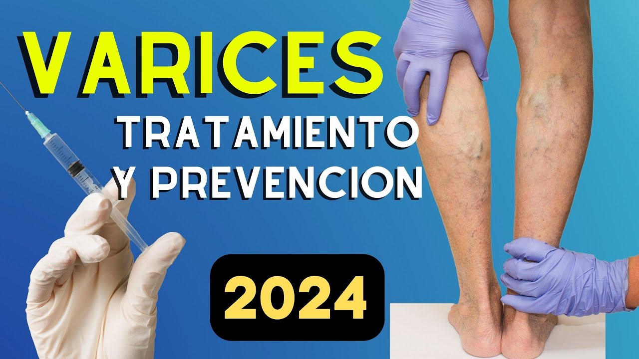 🌵 𝗩𝗔𝗥𝗜𝗖𝗘𝗦 Causas, Tratamiento y Como Prevenirlas 2024 Dra. Linda Lievano