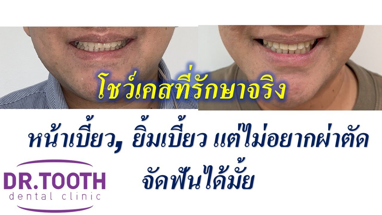 คางเบี้ยว หน้าเบี้ยว ยิ้มเบี้ยว จัดฟันแบบไม่ผ่าตัด คนที่กลัวการผ่าตัดเชิญทางนี้ #จัดฟันที่ไหนดี 