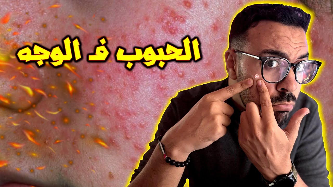 عندك الحبوب فـ وجهك وذاتك ؟ - ضروري تفرج فهاد الفيديو !!