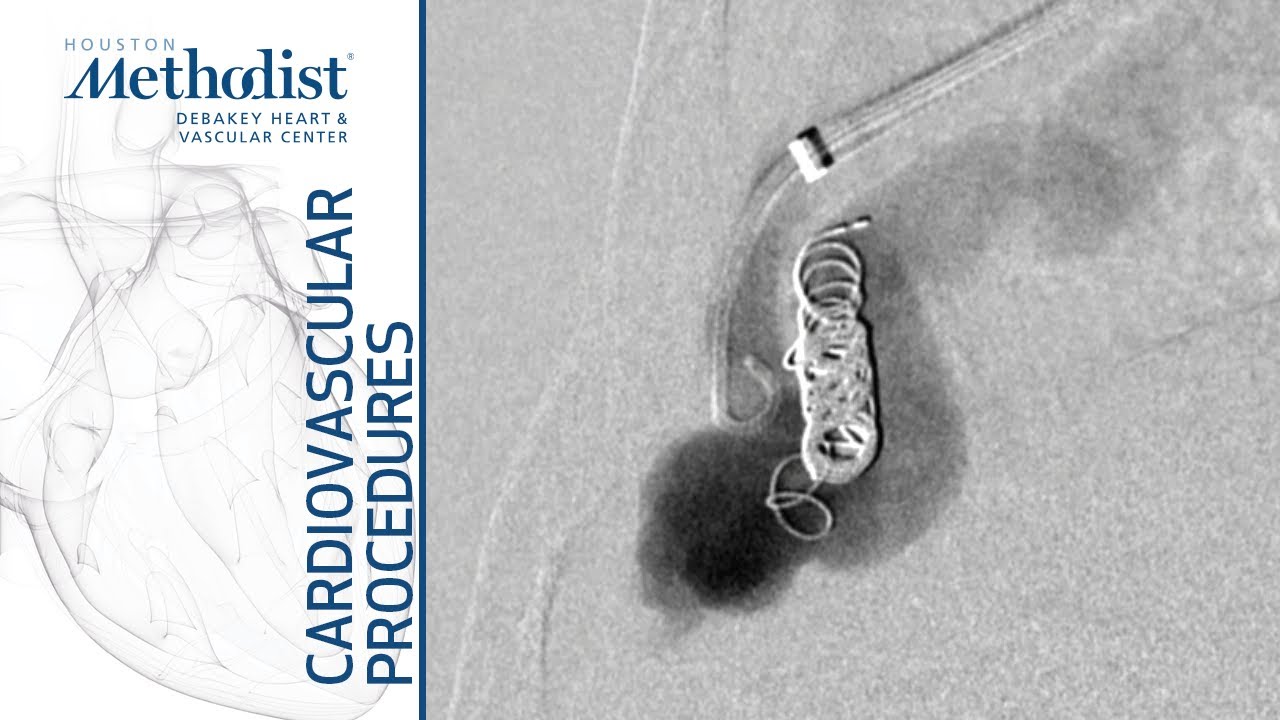 Pulmonary Arteriovenous Malformation Coil Embolization & Plug Placement (Lumsden, MD; Zubair, MD)