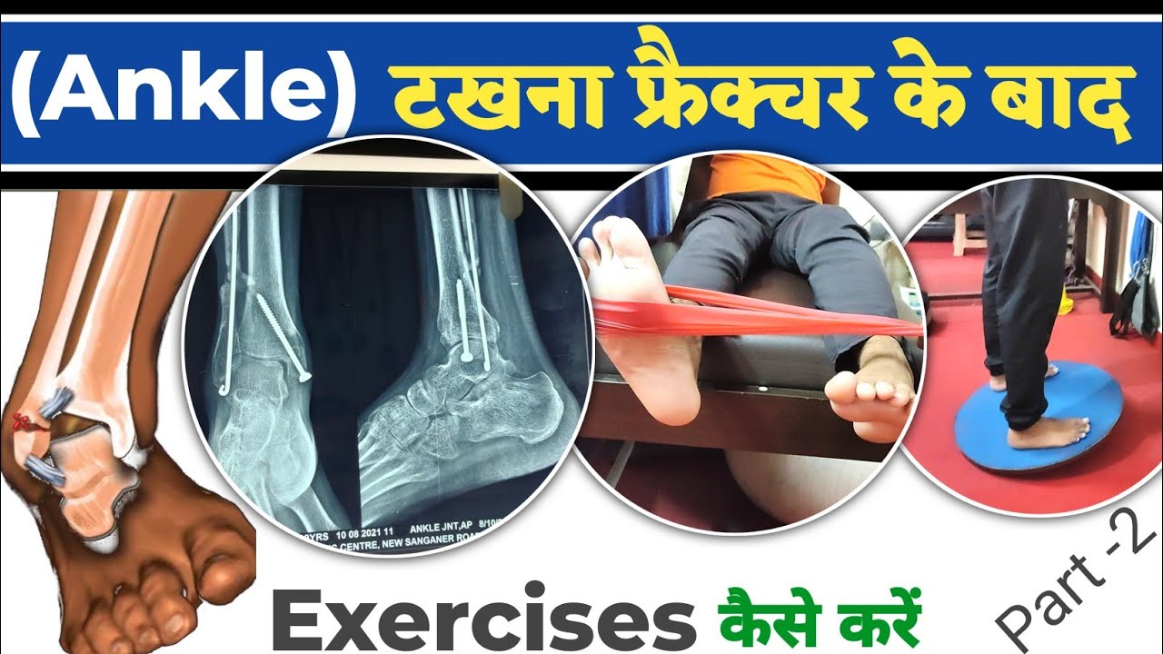 Physiotherapy after Ankle Fracture Surgery | टखने की एक्सरसाइज | Ankle Fracture Exercises in Hindi