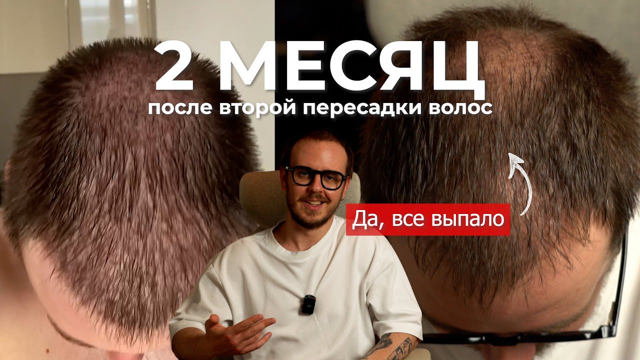 2 МЕСЯЦ после ПЕРЕСАДКИ ВОЛОС (второй)
