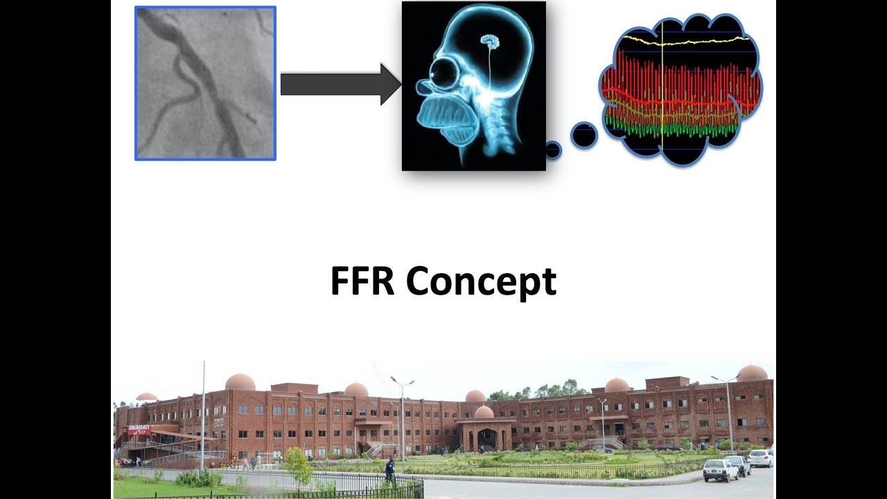 2 FFR Concept in Coronary Physiology