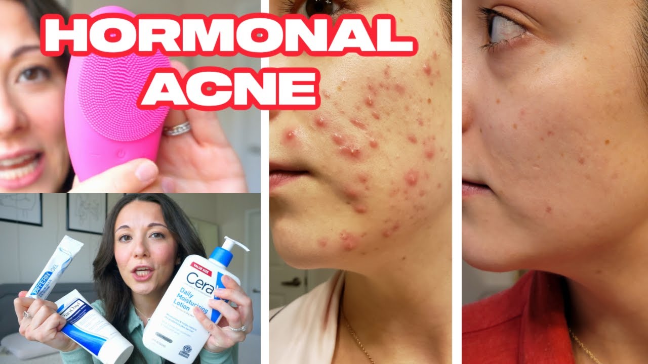 HOW I CLEARED MY CYSTIC ACNE | Acne from Gut Health | Duvolle Sonic Facial Brush