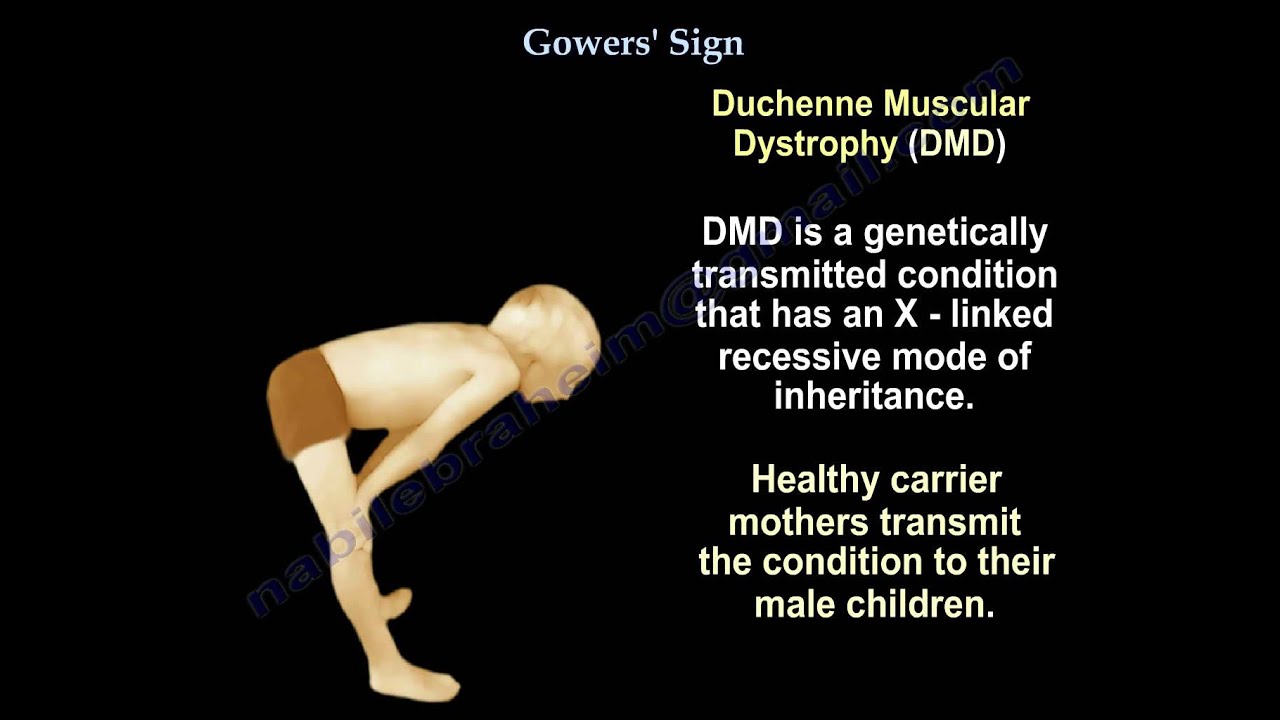 Gowers' Sign - Everything You Need To Know - Dr. Nabil Ebraheim