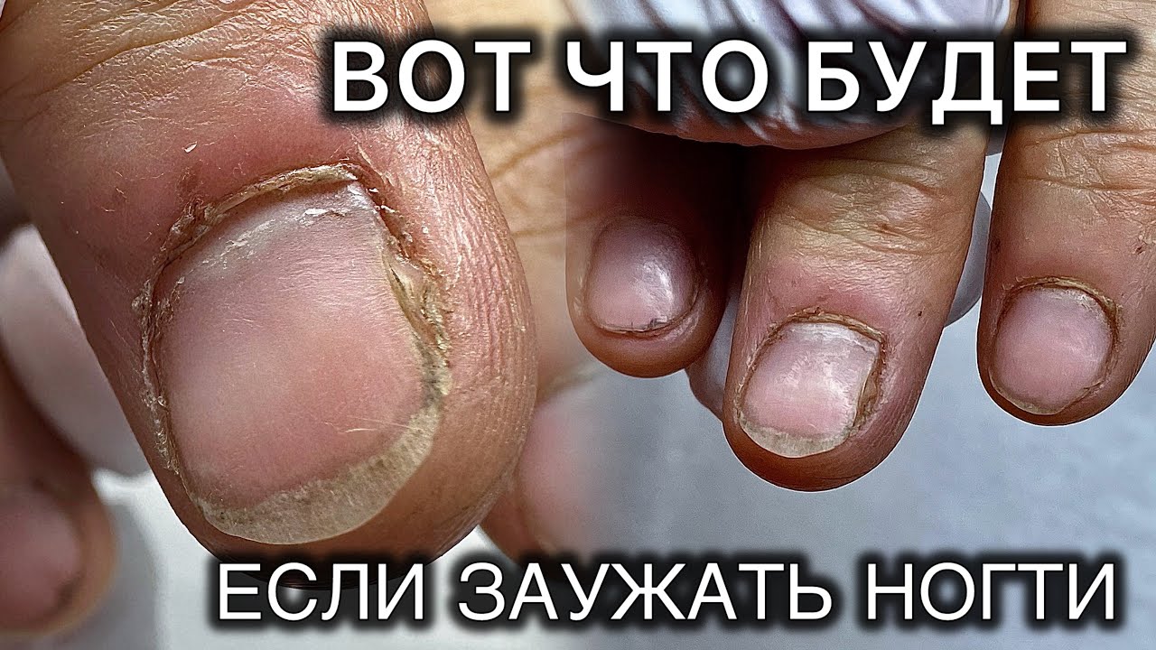 ОНА САМА СЕБЕ НАВРЕДИЛА #аленалаврентьева #подолог #подология #обучениеподологии #ногти