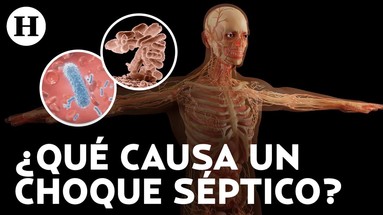 ¿Qué es un choque séptico? Padecimiento que te puede llevar a la muerte; síntomas y causas