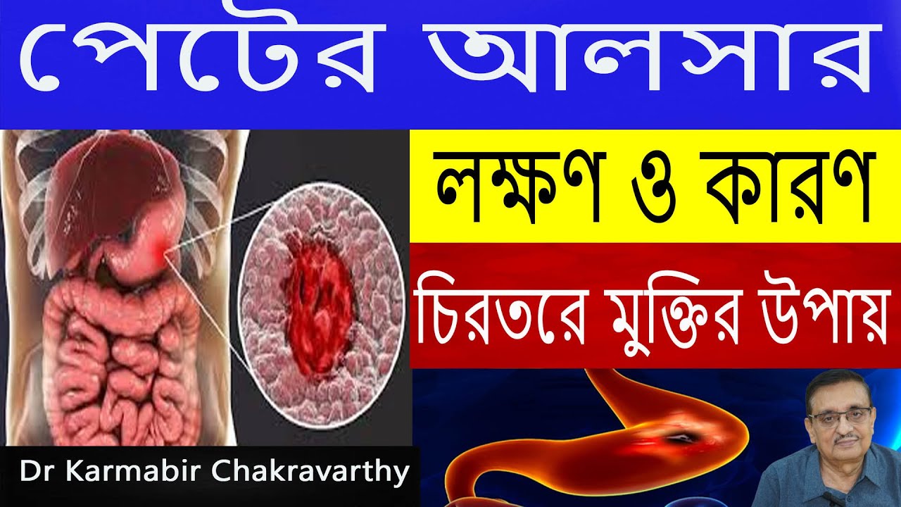 পেটের আলসার থেকে মুক্তির   উপায়ে || পেটের আলসারের লক্ষণ ও কারণ || Peptic Ulcer Disease