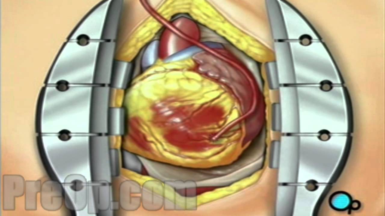 Coronary Artery Bypass Graft (CABG off-pump) PreOp&reg; Patient Engagement and Education