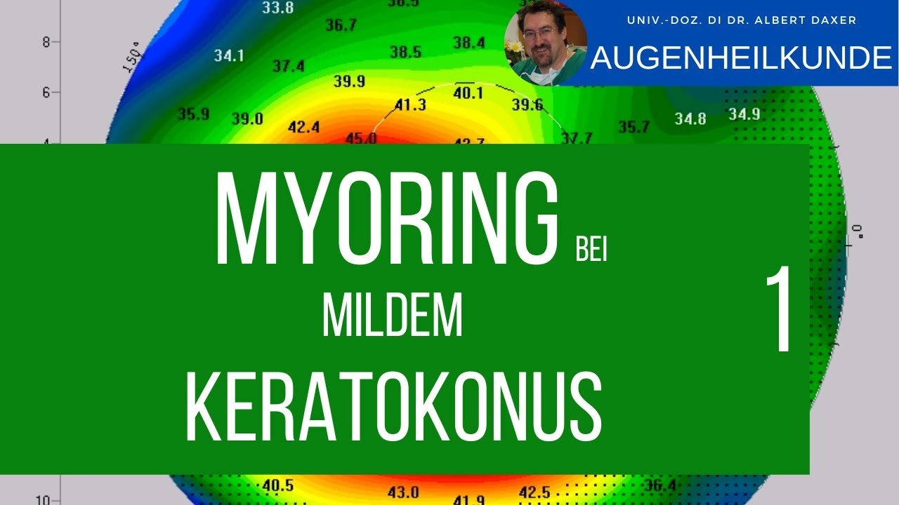 Keratokonus: Ergebnisse der CISIS / MyoRing Behandlung
