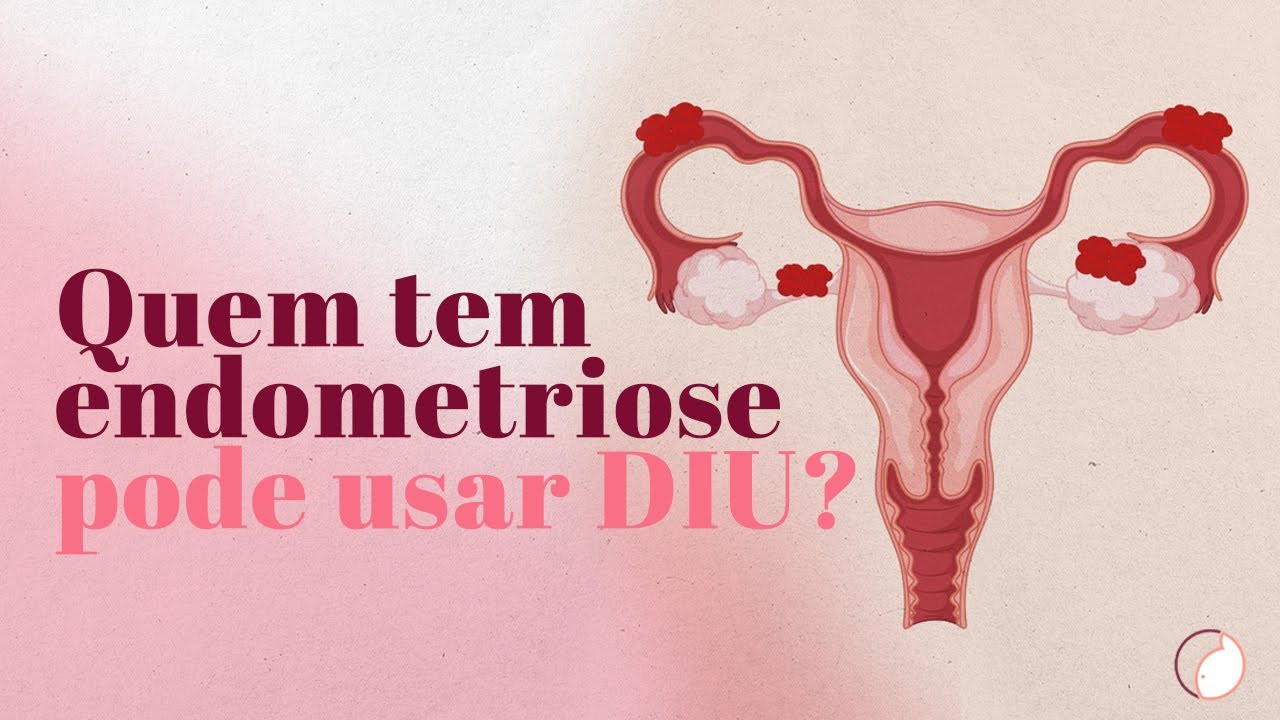 Quem tem endometriose pode usar DIU?