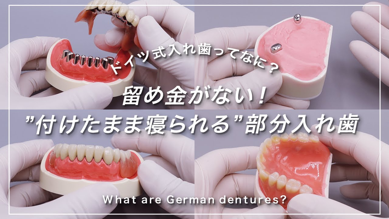 留め金がない！”付けたまま寝られる”部分入れ歯　〜ドイツ式入れ歯ってなに？〜