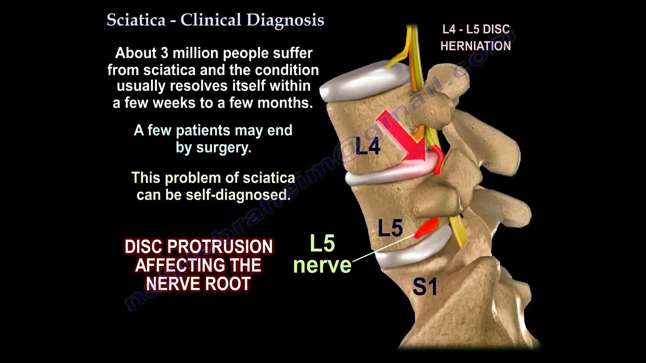 Sciatica causes, Clinical Diagnosis  and treatment.