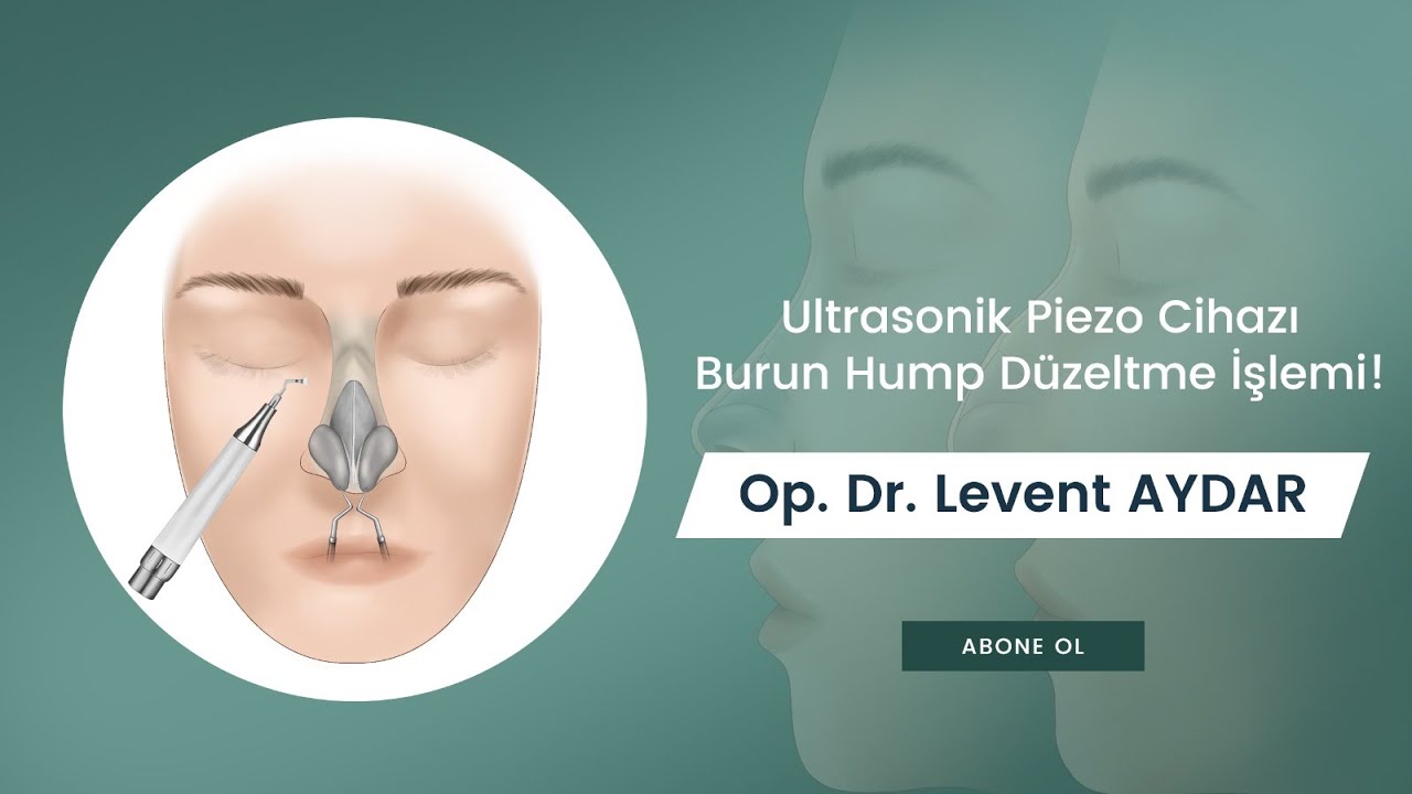 Rinoplasti ameliyatı | Burun hamp düzeltme | Op. Dr. Levent Aydar