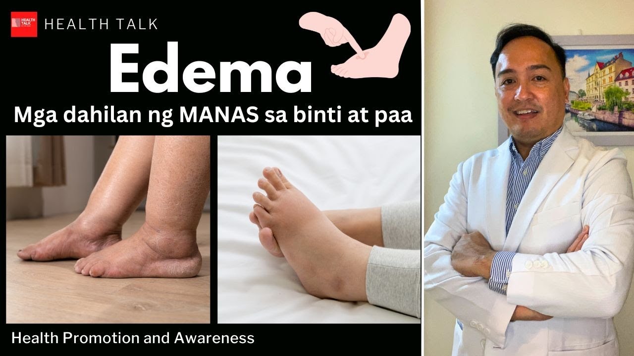 Edema: Ano ang mga dahilan sa MANAS sa binti at paa? Paano ito nagagamot?