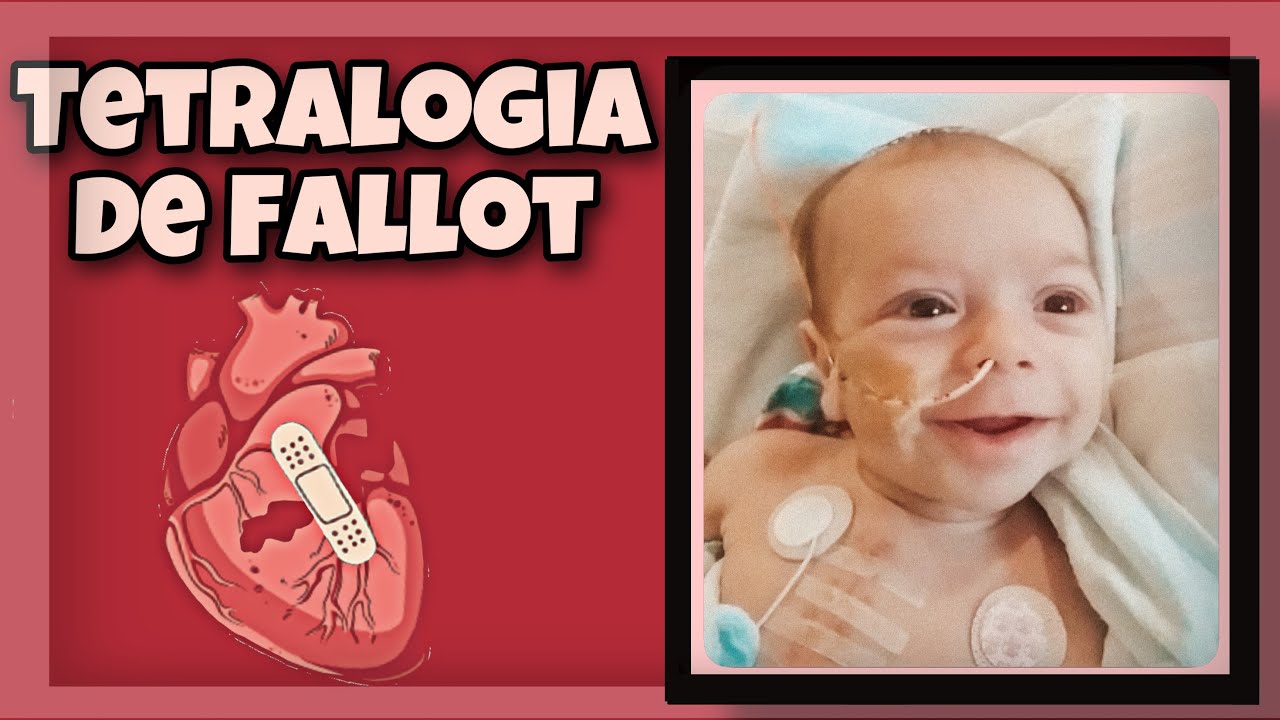 Tetralogia de Fallot | Primeira cirurgia do coração