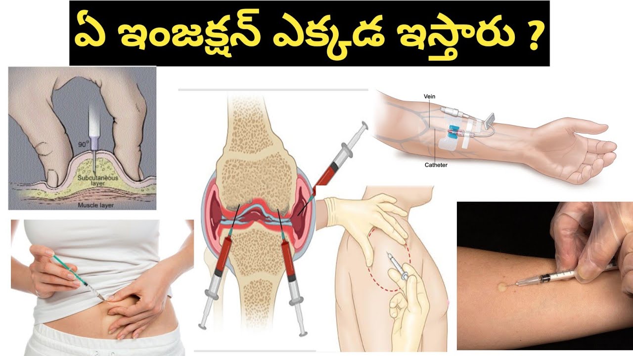 Types of Injections in Telugu ( IV, IM , SC, Intradermal Injection)