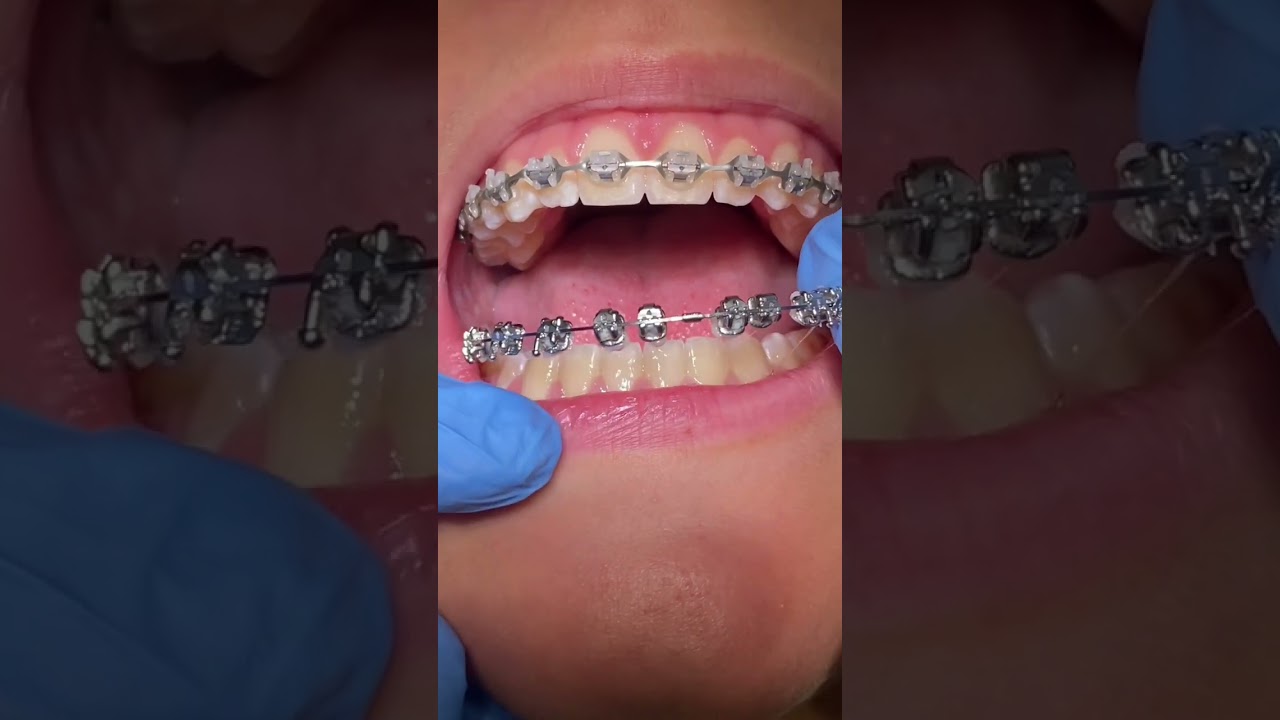 BRACES OFF‼️ #shullmanorthodontics #reels