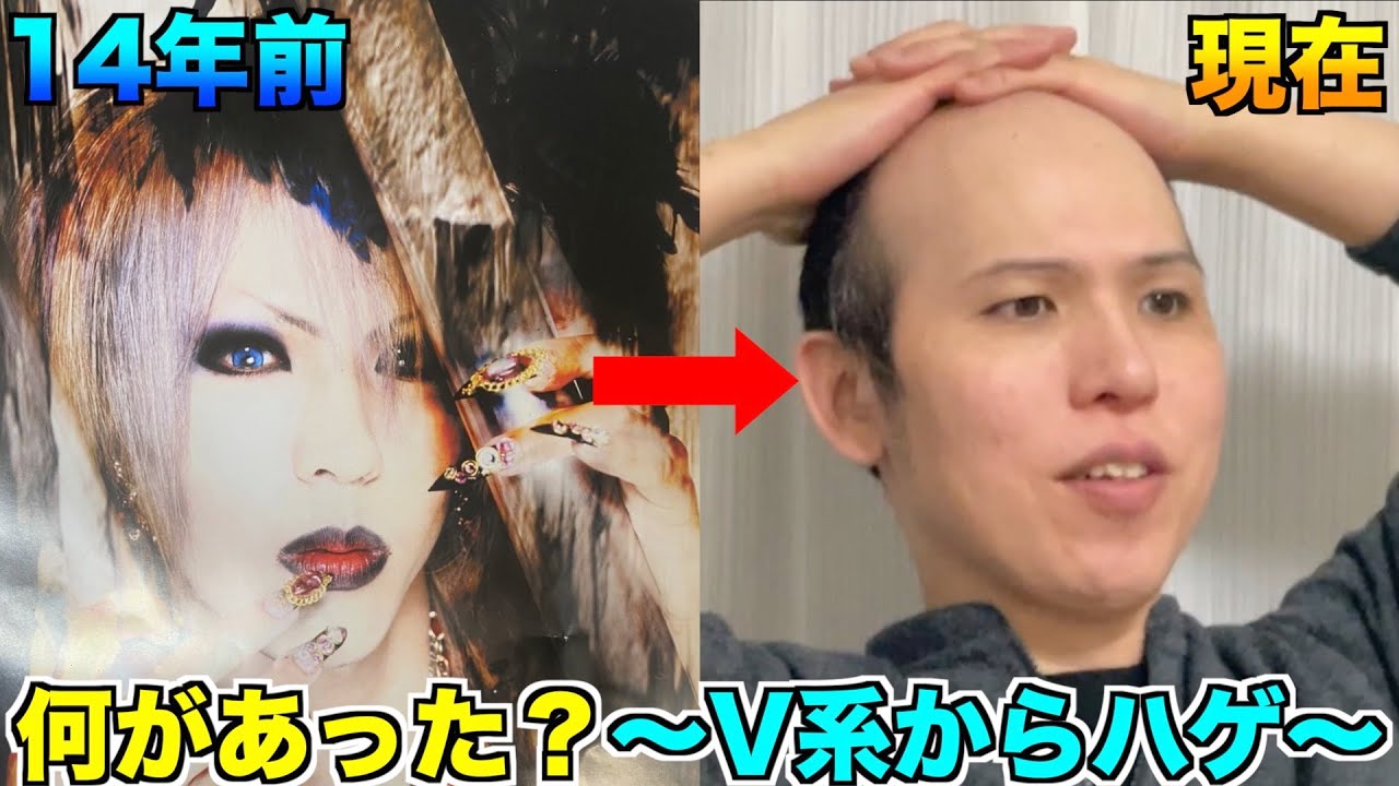 【ビジュアル系→ハゲ】ハゲがハゲる前のイケメン時代の女事情とは？