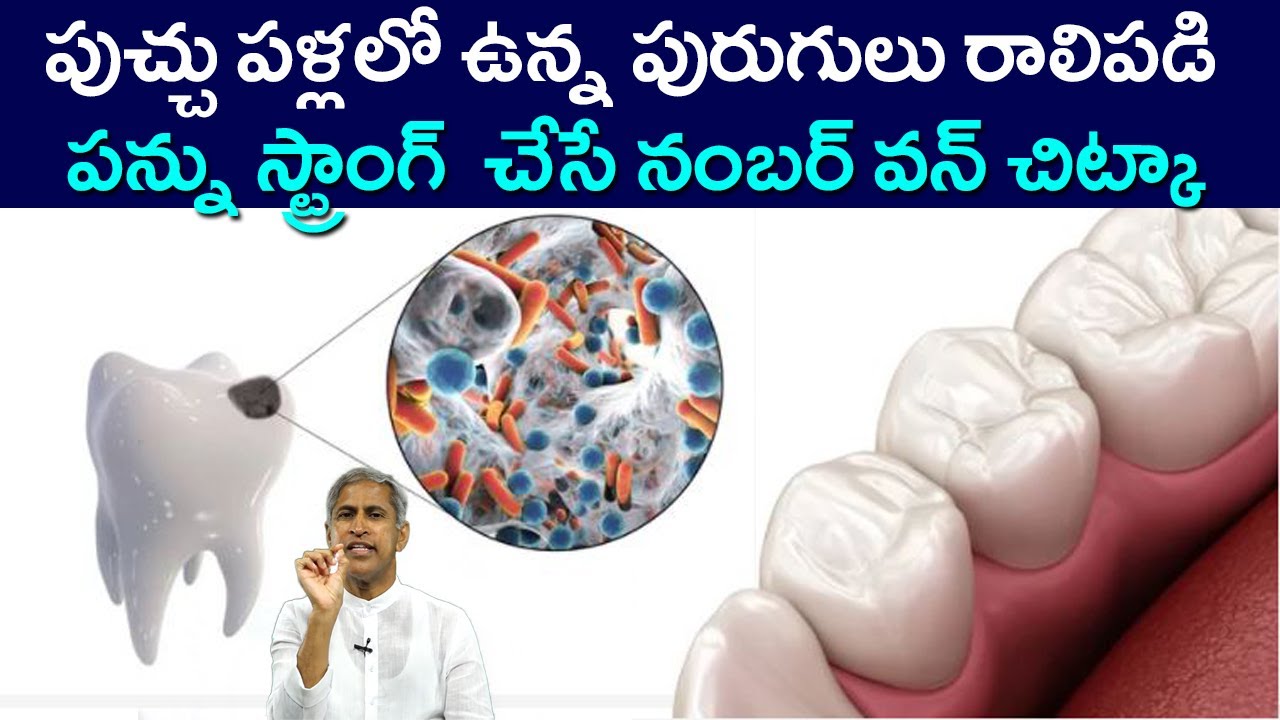 పుచ్చు పళ్లలో పురుగులు రాలిపడి పన్ను స్ట్రాంగ్  చేసే నంబర్ 1 చిట్కా | Dr Manthena Satyanarayana Raju