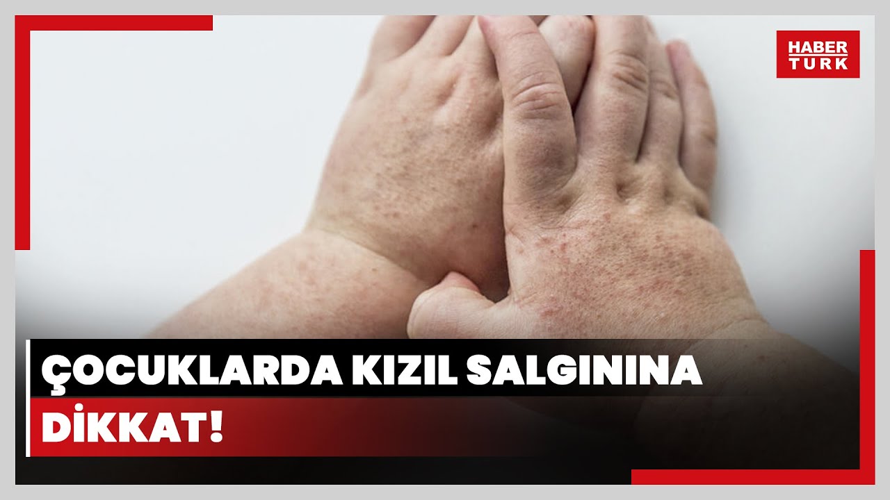 Çocuklarda kızıl salgınına dikkat
