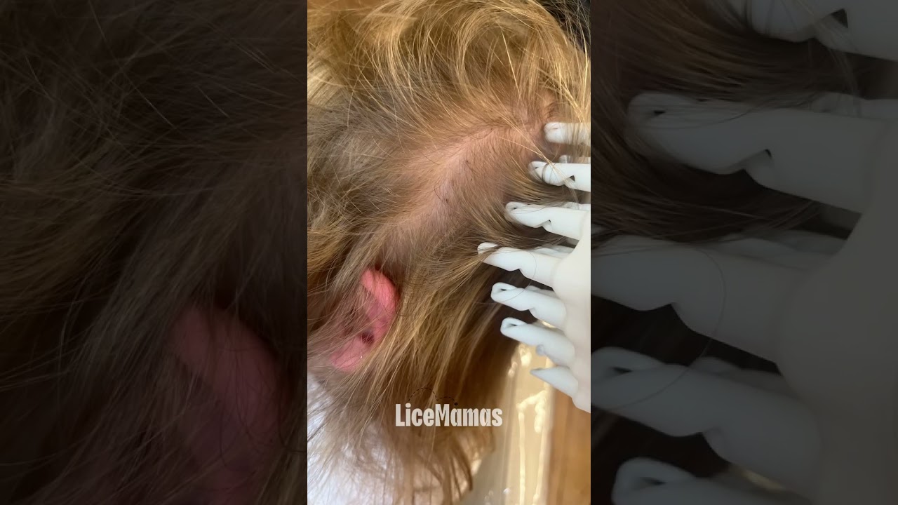 Zeg vaarwel tegen luizen op een veilige, snelle en chemicali&euml;nvrije manier! ✨