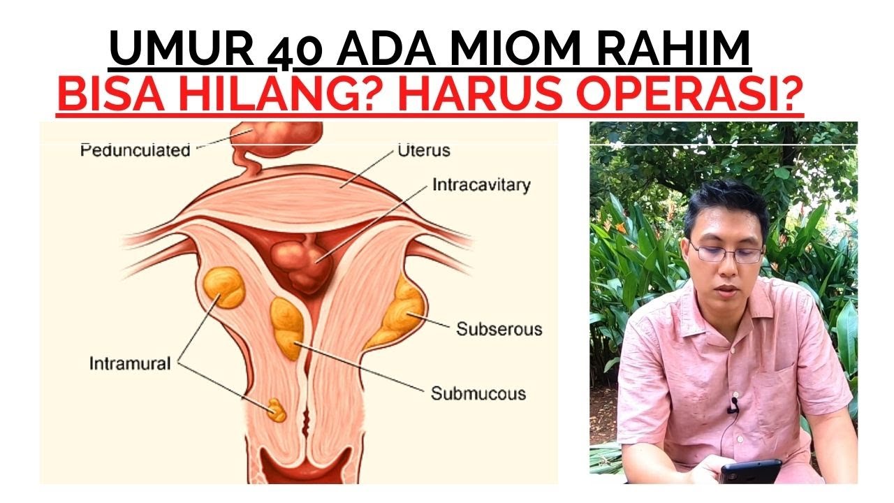 Umur 40 Miom Apakah Harus Dioperasi | dr. Erfenes Ho