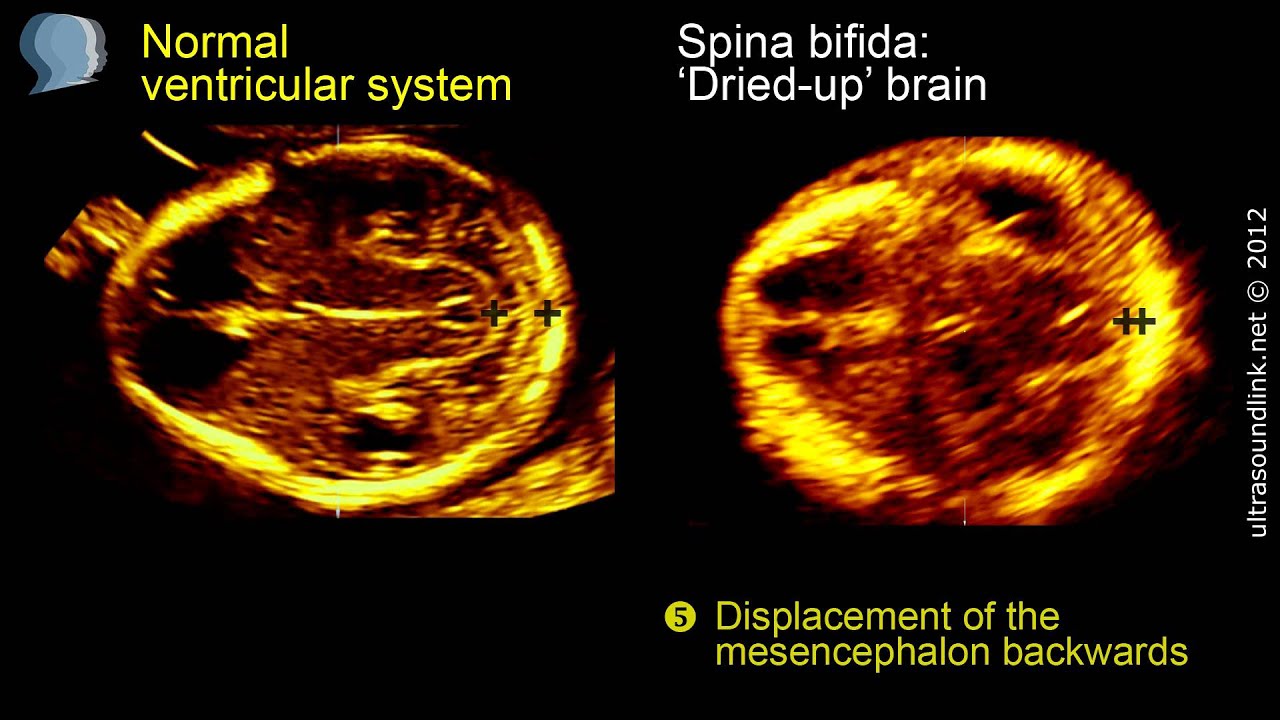 Spina bifida: 3D ultrasound diagnosis at 11-13 weeks