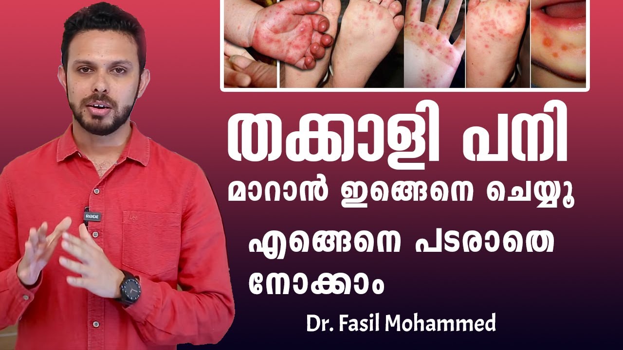 തക്കാളി പനി ലക്ഷണങ്ങൾ,  മാറാൻ എന്ത് ചെയ്യണം| Thakkali pani malayalam | Hand foot mouth disease |HFMD
