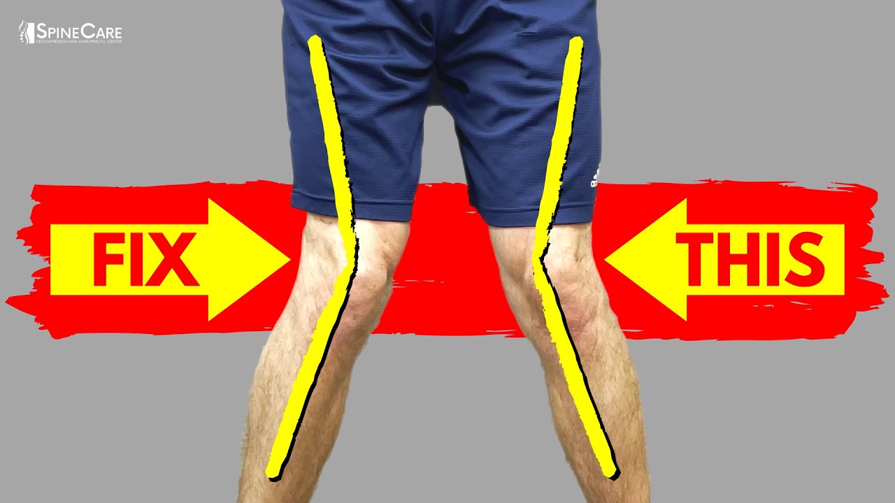 The Best Ways to Fix Knock Knees (AT HOME!)