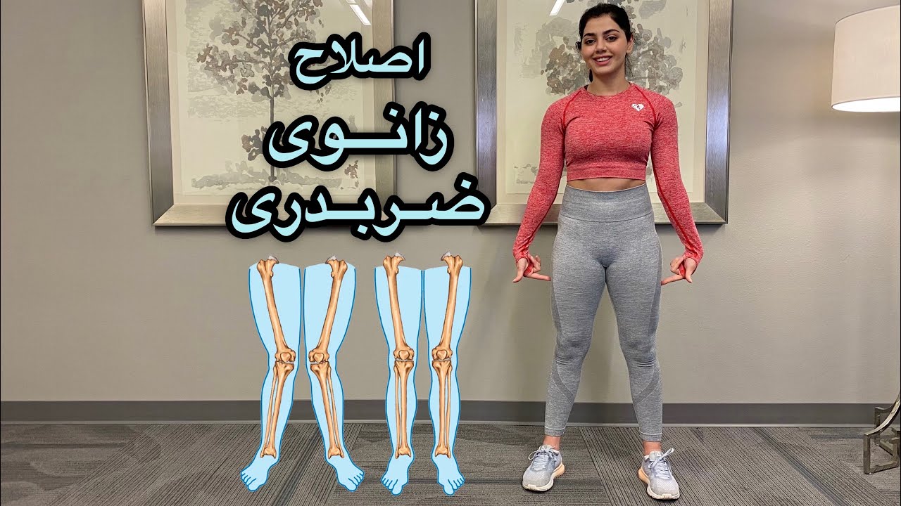 اصلاح زانوی ضربدری / پای ضربدری