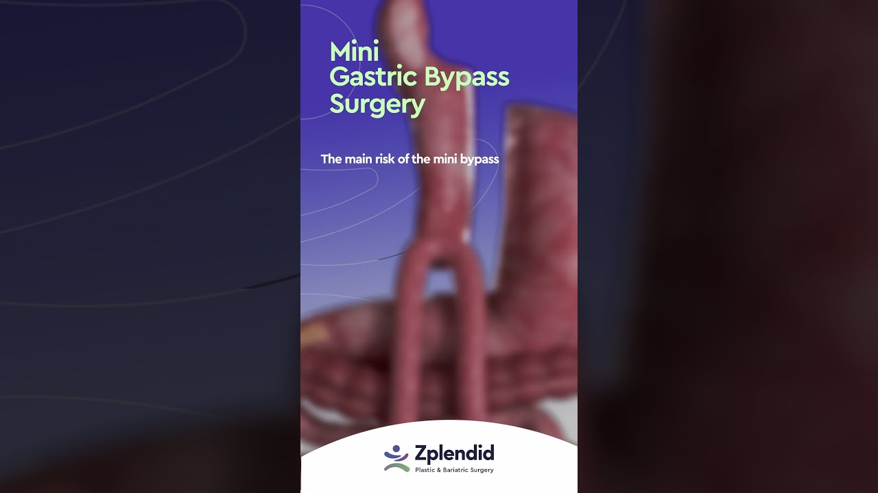 How Mini Gastric Bypass (MGB) works with Dr. Francisco Zavalza