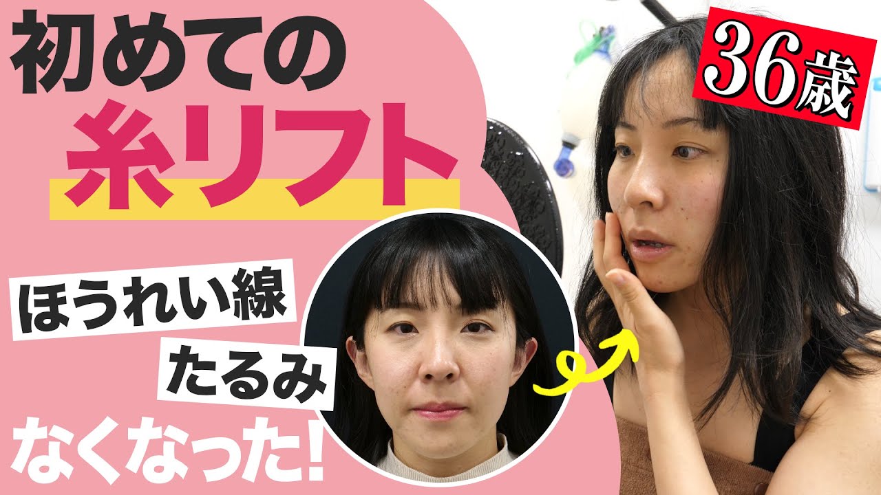 【アラサーたるみ整形密着】糸リフトで若返りたい！ほうれい線・たるみの改善【36歳初めての糸リフト】