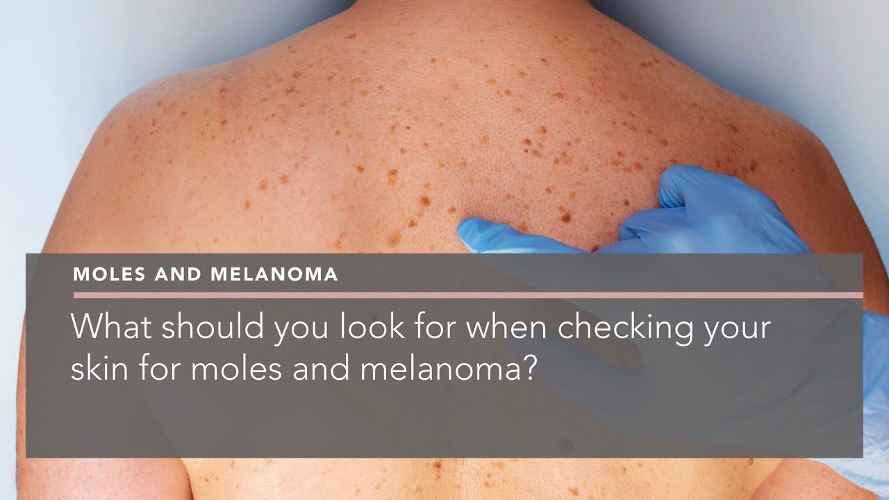 What should you look for when checking your skin for moles and melanoma?