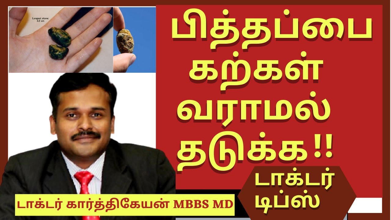 gallbladder stones treatment in tamil | pitha pai kal | பித்தப்பை கற்கள் | dr karthikeyan tamil