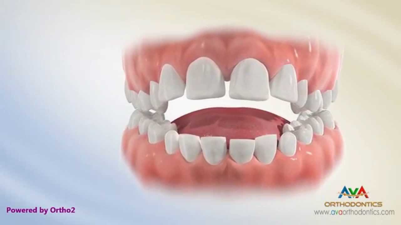 Orthodontic Treatment for Tongue Thrusting Habit - Different Options