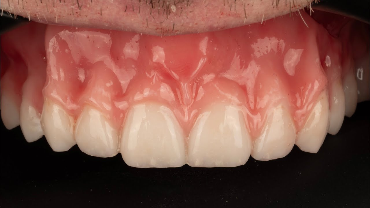 3D Printed Denture