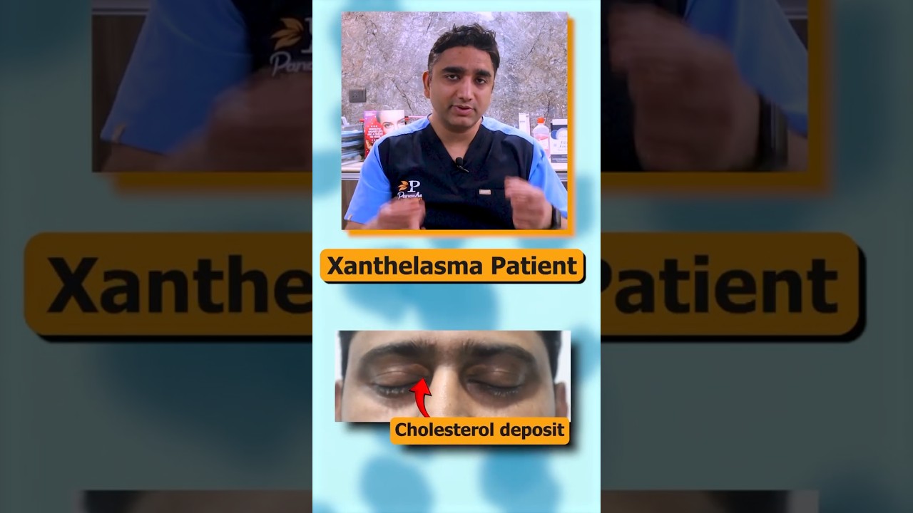 How to Get Rid of Xanthelasma or Fatty Deposits of Cholesterol on Eyelids - Xanthelasma Treatment