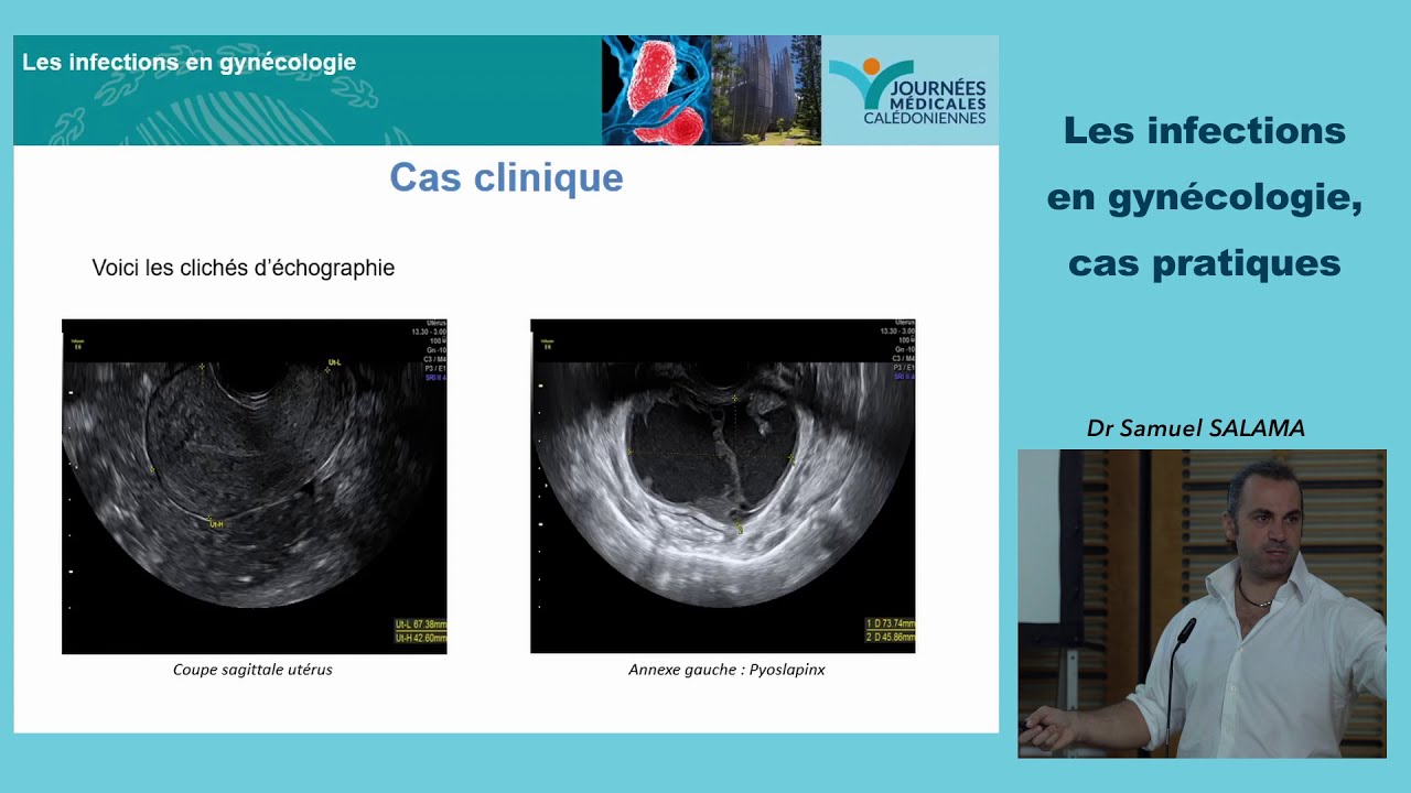 Les infections en gynécologie, cas pratiques