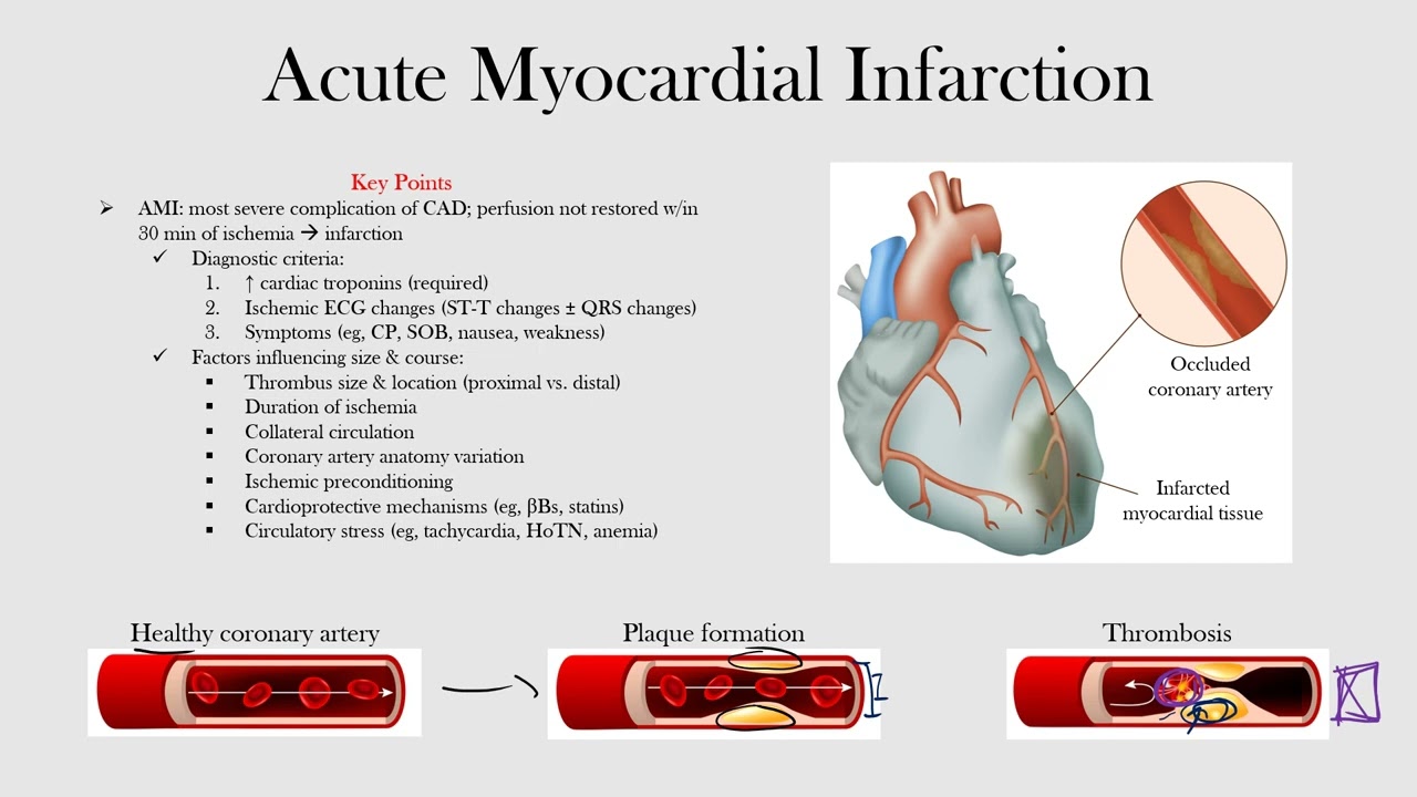 Acute Myocardial  Infarction