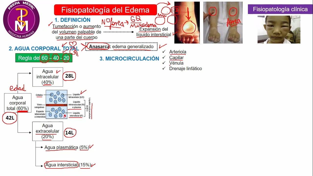 FISIOPATOLOGIA DEL EDEMA // PREPAMEDIC