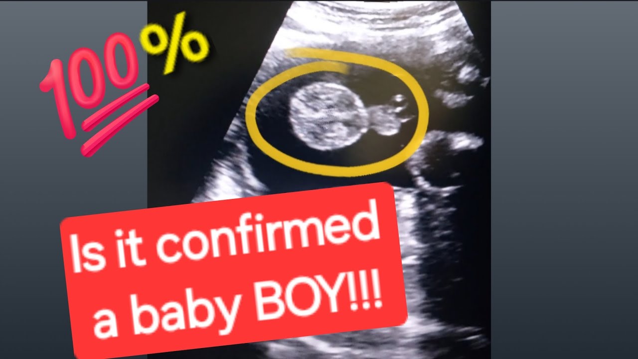 31, 17 &12 Weeks Pregnancy Scan | MCDA Twins | Anterior/ Posterior Placenta means Baby Boy Or Girl